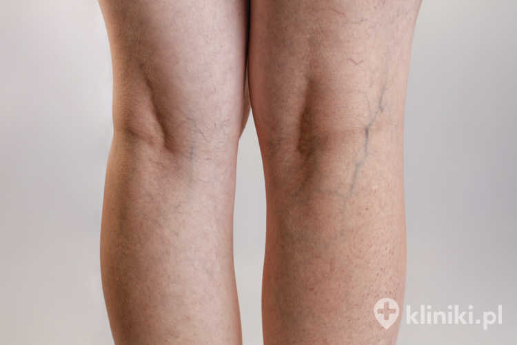Leczenie żylaków nóg