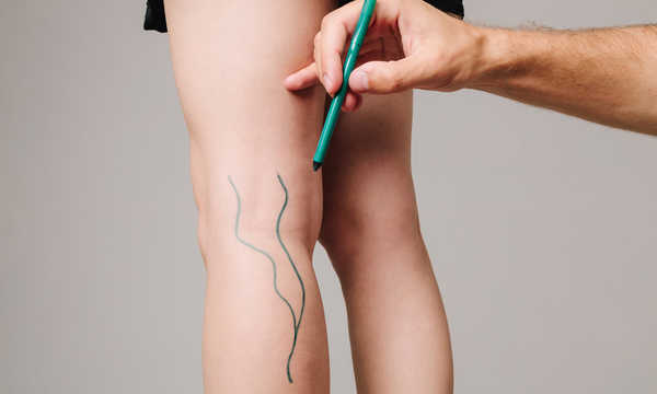 Lekarz chirurg naczyniowy decyduje, czy dalsza diagnostyka lub leczenie zabiegowe są konieczne