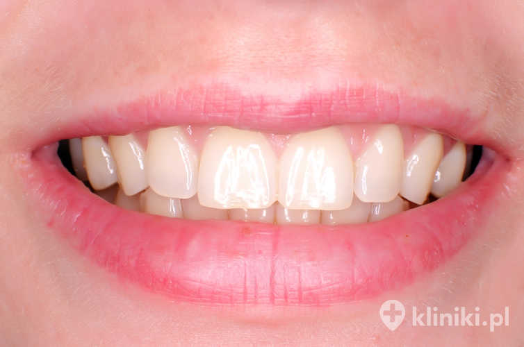 Licówki porcelanowe pozwalają poprawić kształt, kolor i proporcje zębów, zapewniając bardzo naturalny efekt estetyczny