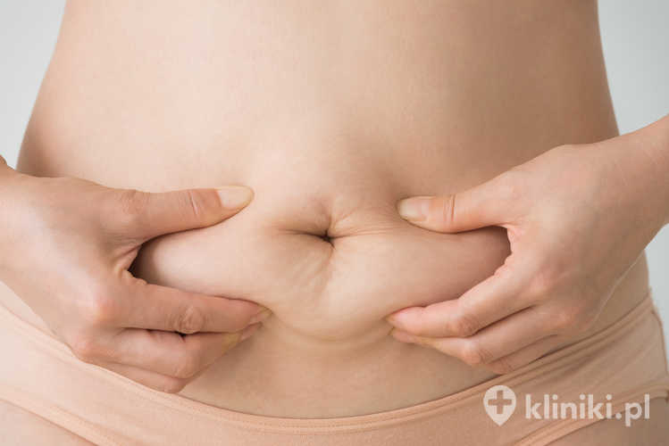 Mankietowa resekcja żołądk