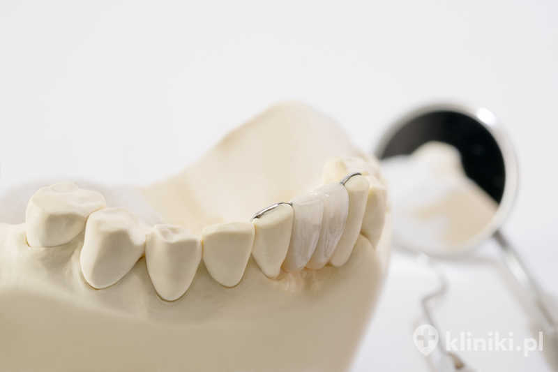 Most dentystyczny Maryland Most dentystyczny Maryland