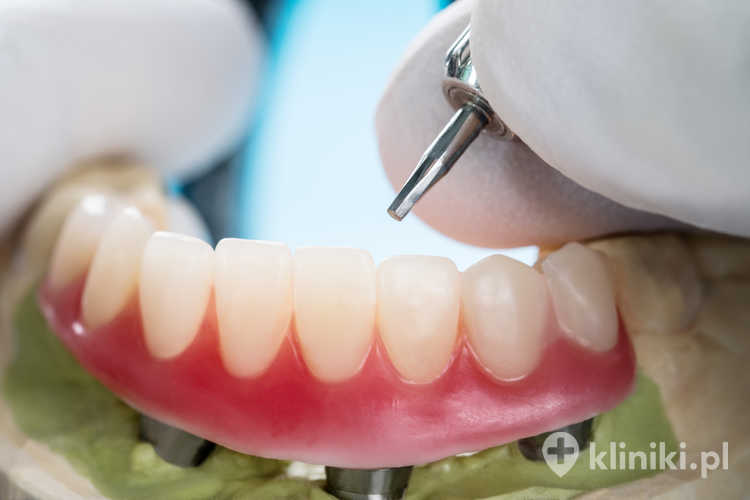 Proteza oparta na implantach zapewnia bardzo dobrą stabilność i jest tańszą alternatywą dla pełnej pracy stałej