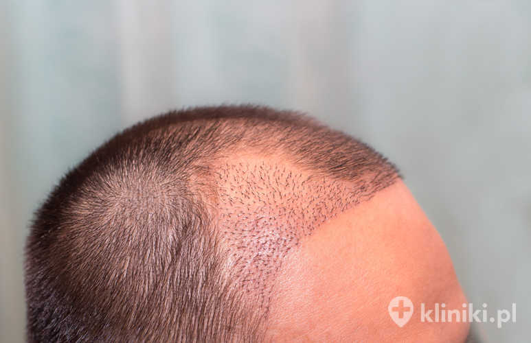 Przeszczep włosów po urazie lub oparzeniu jest metodą rekonstrukcyjną stosowaną w celu odtworzenia owłosienia w miejscach blizn pourazowych