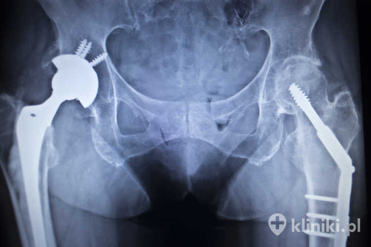 Endoprotezy biodra mogą różnić się także materiałem wykonania, na przykład metal–polietylen, ceramika–ceramika lub ceramika–polietylen