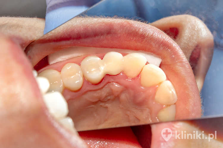 Implanty zębowe Neobiotech znajdują zastosowanie zarówno w standardowych przypadkach implantacji, jak i w procedurach natychmiastowego lub wczesnego obciążenia