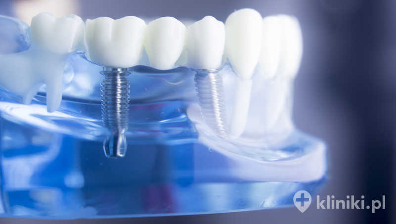 Korona porcelanowa na podbudowie metalowej jest często stosowana w odcinkach bocznych, gdzie działają duże siły żucia Korona porcelanowa na podbudowie metalowej jest często stosowana w odcinkach bocznych, gdzie działają duże siły żucia