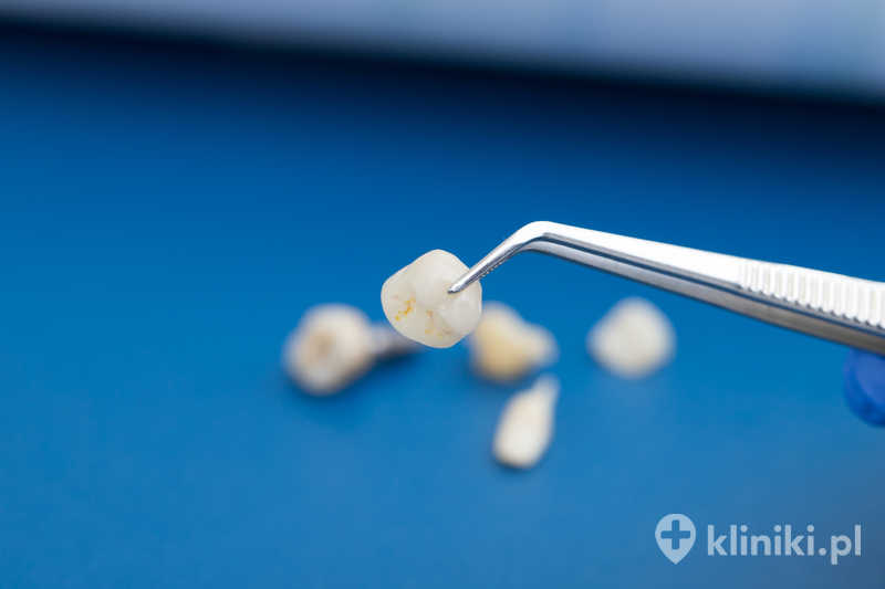 Korona porcelanowa pełnoceramiczna charakteryzuje się wysoką estetyką, dzięki czemu jest szczególnie polecana do odbudowy zębów przednich