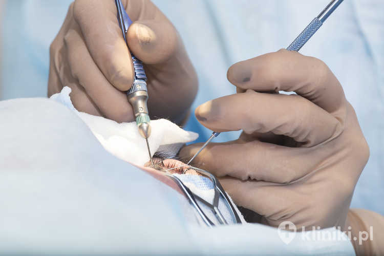 Laserowe leczenie zaćmy umożliwia bardzo dokładne wykonanie kapsulotomii oraz przygotowanie soczewki do usunięcia