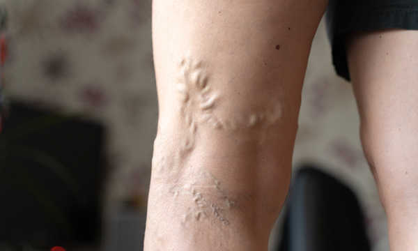 Leczenie przyczynowe żylaków kończyn dolnych polega na usunięciu niewydolnych żył i wyeliminowaniu cofania się krwi w układzie żylnym