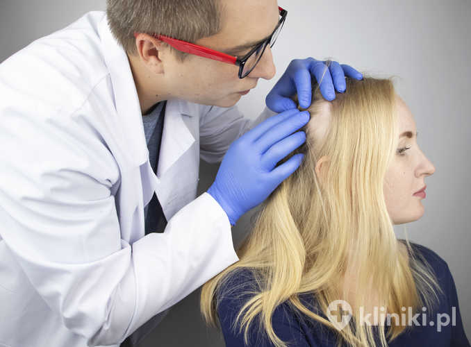 Leki na łysienie plackowate z grupy inhibitorów JAK stanowią przełom w leczeniu tej choroby autoimmunologicznej