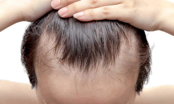 Przeszczep włosów metodą S.A.F.E.R. to nowoczesna odmiana techniki FUE wykorzystująca system ssący do pobierania mieszków włosowych