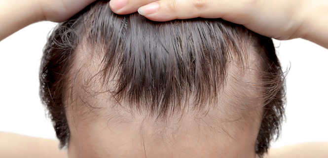 Przeszczep włosów na zakola metodą S.A.F.E.R.