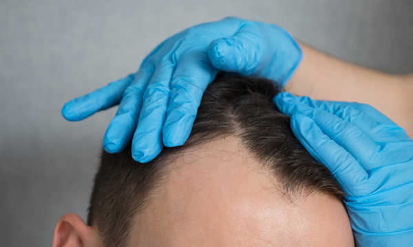 Przeszczep włosów metodą Smart Graft charakteryzuje się krótkim czasem rekonwalescencji i minimalnym ryzykiem powstawania blizn