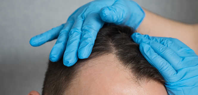 Przeszczep włosów metodą Smart Graft