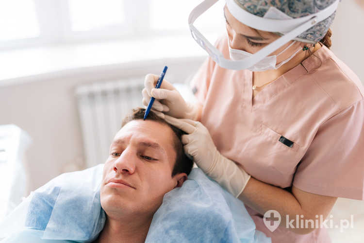 Przeszczep włosów metodą Smart Graft pozwala na precyzyjne i małoinwazyjne pobieranie graftów bez konieczności wycinania paska skóry.