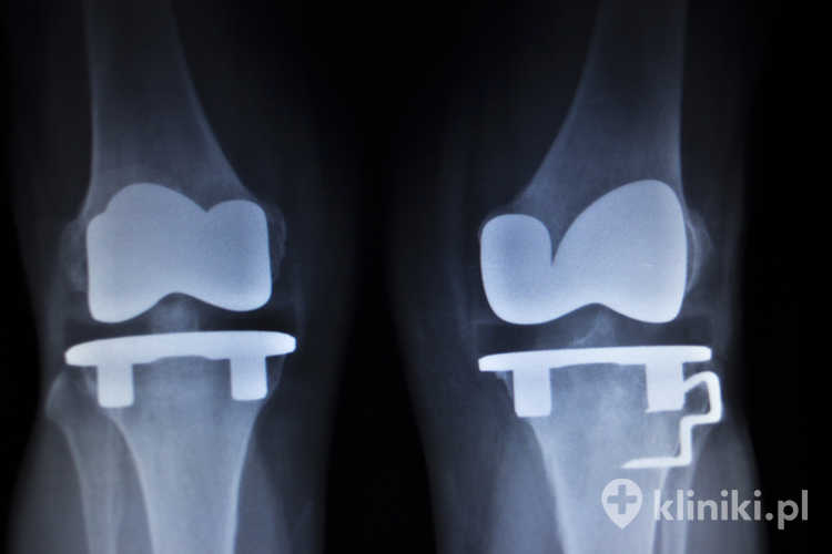Przy pomocy wszczepienia endoprotezy kolana leczy się również wady osi kończyny z zaawansowanymi zmianami zwyrodnieniowymi, których nie da się skorygować metodami zachowawczymi