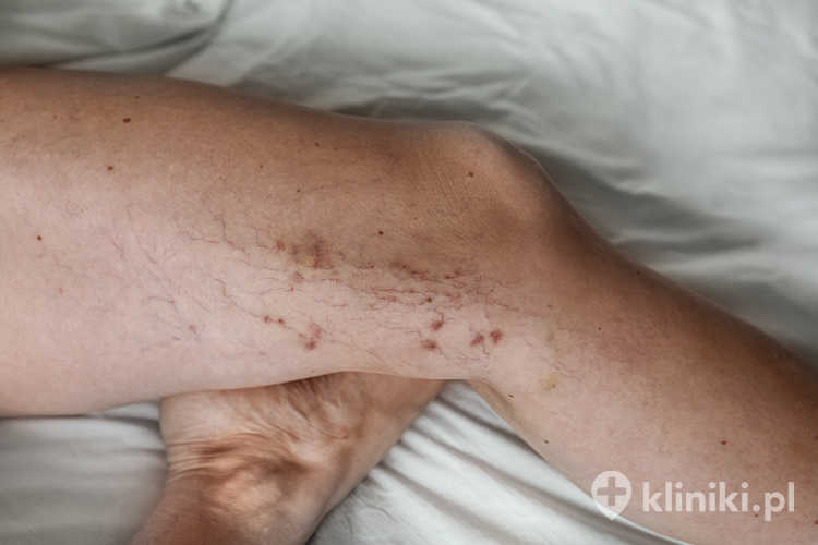 Przyczynowe leczenie żylaków nóg obejmuje nowoczesne metody, takie jak laseroterapia endowenozna, ablacja falami radiowymi czy skleroterapia