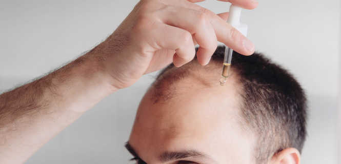 Przyczyny wypadania włosów