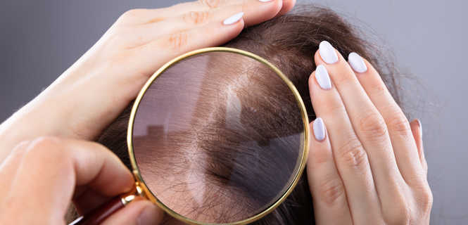 Łysienie telogenowe - przyczyny, objawy i leczenie