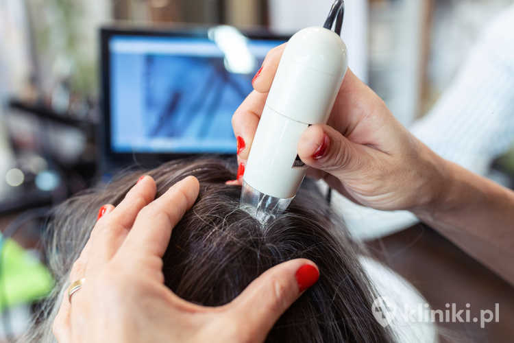 Łysienie telogenowe wymaga diagnostyki przyczyny i jej usunięcia, a leczenie ma głównie charakter wspomagający