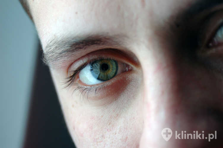 Przeszczep brwi wykonywany jest najczęściej metodami FUE lub DHI, co pozwala na precyzyjne rozmieszczenie włosków zgodnie z naturalnym kierunkiem ich wzrostu