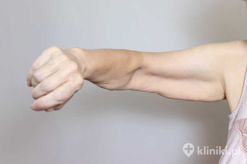 Chirurgiczne modelowanie sylwetki wykonywane jest w celu usunięcia nadmiaru tkanki tłuszczowej i skóry oraz poprawy proporcji ciała