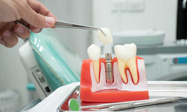 Implanty stomatologiczne charakteryzują się wysoką skutecznością i długotrwałymi efektami potwierdzonymi badaniami klinicznymi