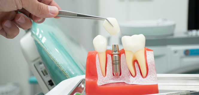 Czy implanty zębów są bezpieczne?