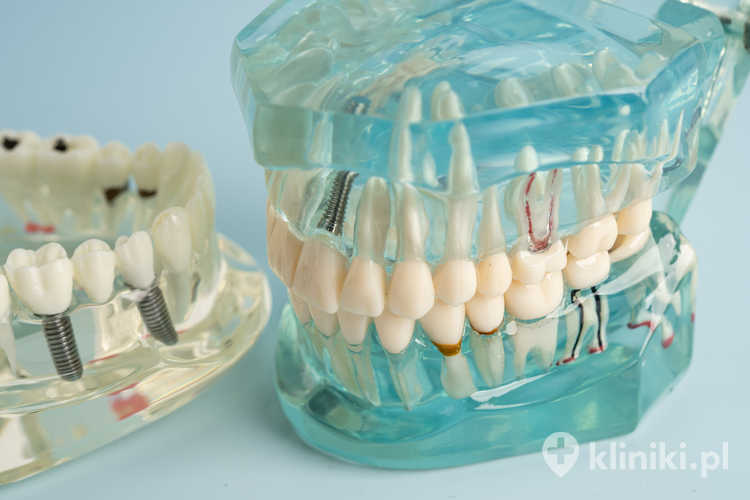 Implanty zębowe Direct znajdują zastosowanie zarówno w pojedynczych odbudowach zębowych, jak i w większych pracach protetycznych