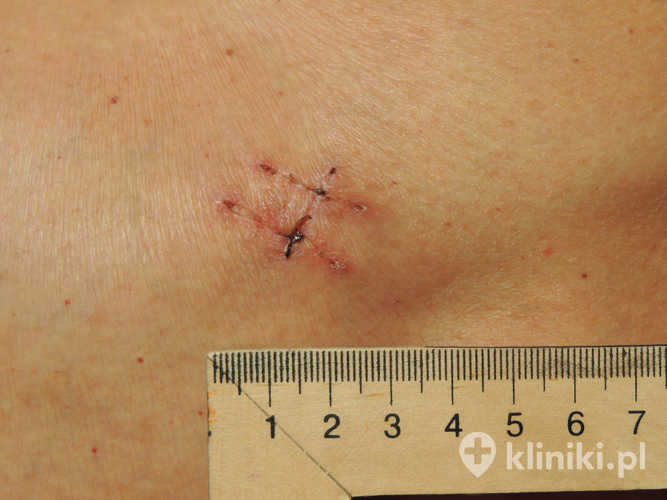 Operacja przepukliny pępkowej metodą Mayo jest techniką „na napięciu”, co oznacza, że brzegi przepukliny są zbliżane bez użycia siatki wzmacniającej