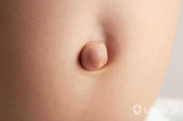 Przepukliny wrodzone powstają na skutek nieprawidłowego rozwoju ściany jamy brzusznej już w okresie życia płodowego