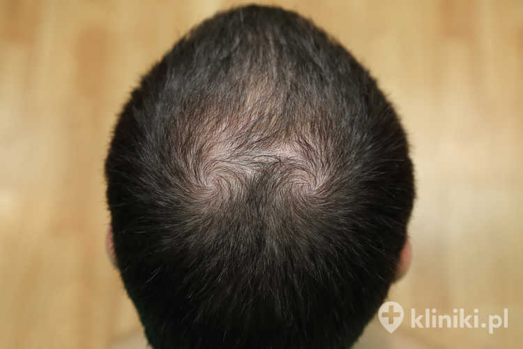 Przeszczep włosów metodą S.A.F.E.R. jest odmianą techniki FUE, która nie wymaga wycinania paska skóry ani zakładania szwów