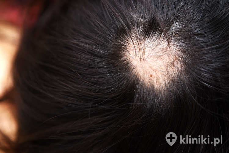Refundacja przeszczepu włosów przez NFZ nie jest standardem i w praktyce dotyczy bardzo wąskiej grupy pacjentów