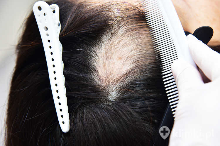Transplantacja włosów z ciała do skóry głowy pozwala na uzupełnienie ubytków w przypadku zaawansowanego łysienia