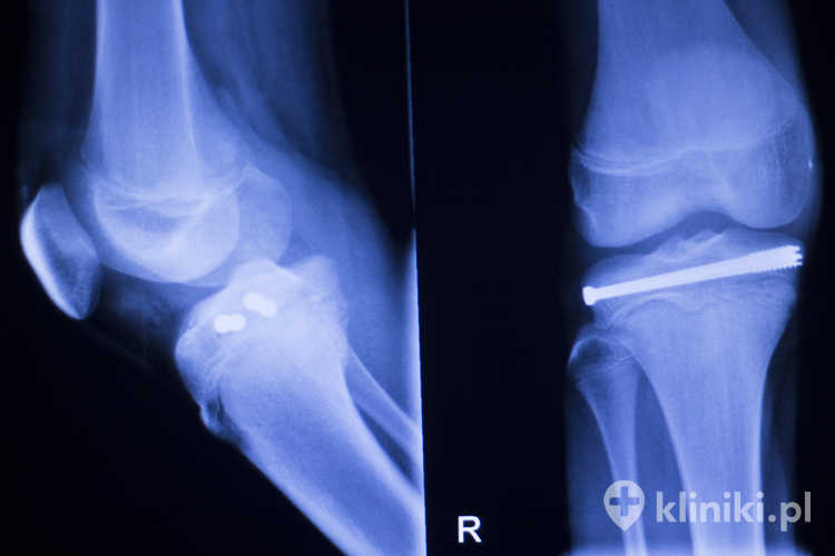 Biowchłanialne implanty ortopedyczne stopniowo ulegają rozkładowi w organizmie, jednocześnie spełniając swoją funkcję leczniczą