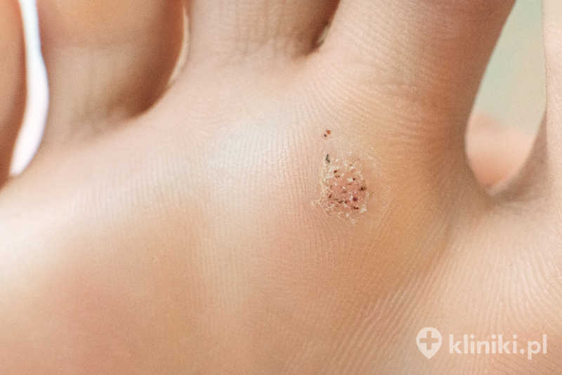 Brodawki wirusowe / kurzajki leczone laserem goją się zazwyczaj bez pozostawienia widocznych blizn