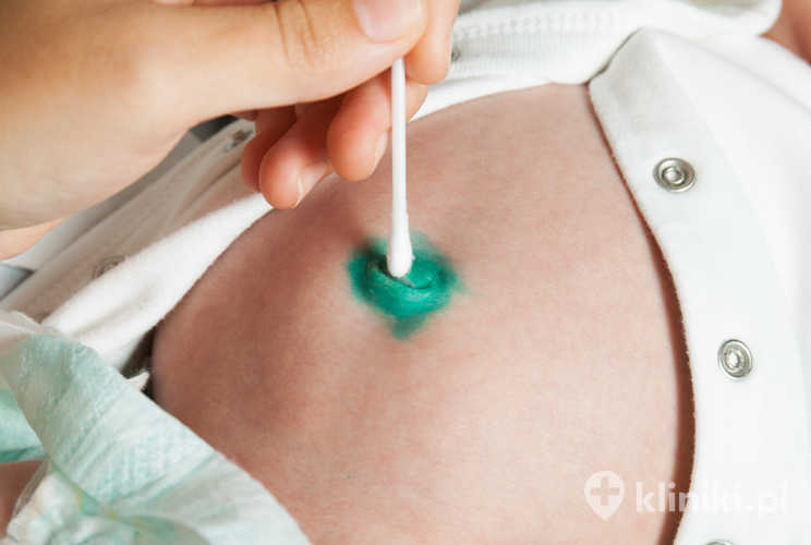 Chirurgiczne zamknięcie przepukliny pępkowej u niemowląt umożliwia prawidłowy rozwój powłok brzusznych i szybki powrót do zdrowia