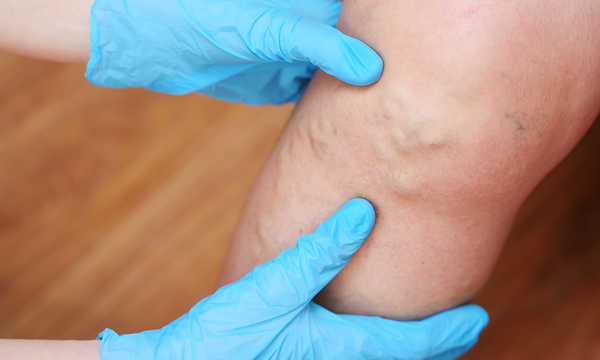 Echoskleroterapia żylaków pozwala na bardzo precyzyjne podanie środka obliterującego bez konieczności operacji