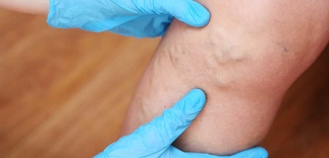 Echoskleroterapia żylaków - co to za zabieg?