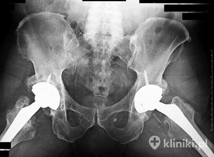 Endoproteza stawu biodrowego umożliwia płynne poruszanie się dzięki współpracy sztucznej głowy kości udowej i panewki