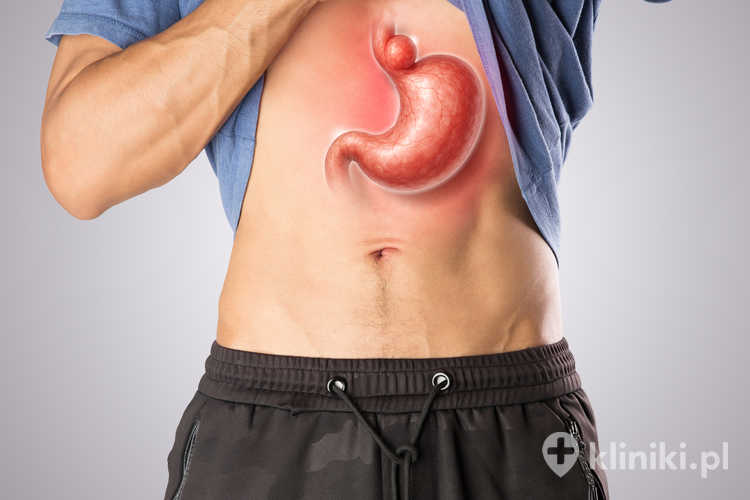 Hernia hiatus oesophagei może mieć różne postacie, z których najczęstsza jest postać ślizgowa