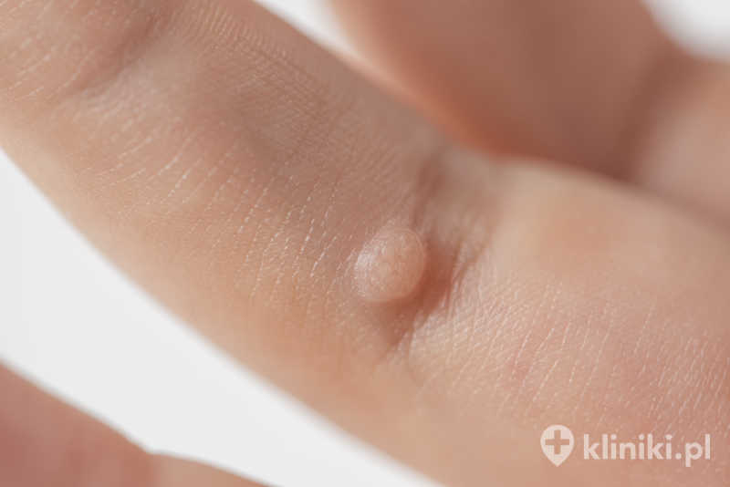 Kurzajki przed zabiegiem wymagają kwalifikacji przez lekarza