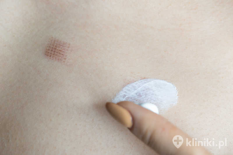 Laseroterapia zmian skórnych skraca czas gojenia i zmniejsza ryzyko powstania blizn