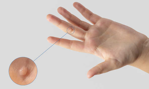 Laserowe usuwanie brodawek wirusowych / kurzajek jest szybkim zabiegiem wykonywanym w warunkach ambulatoryjnych