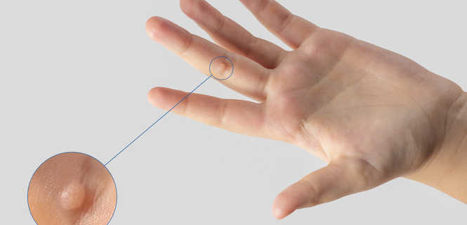 Brodawki wirusowe / kurzajki - usuwanie laserem