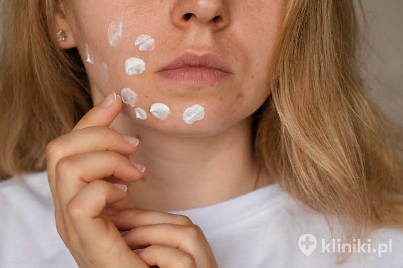 Laserowe usuwanie przebarwień skóry charakteryzuje się krótkim czasem rekonwalescencji i wysoką skutecznością