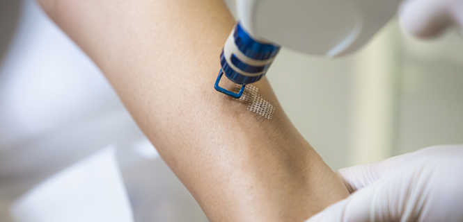 Laserowe usuwanie zmian skórnych