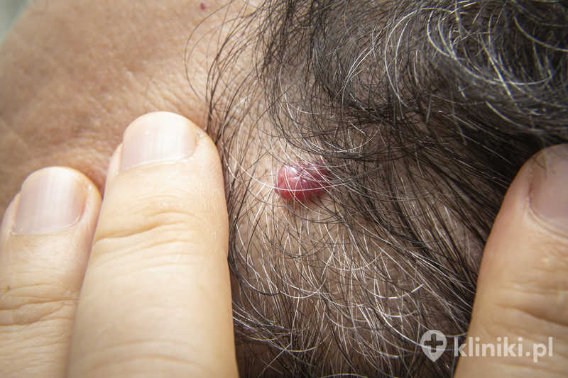 Laserowe usuwanie zmian skórnych wykonywane jest zwykle w znieczuleniu miejscowym