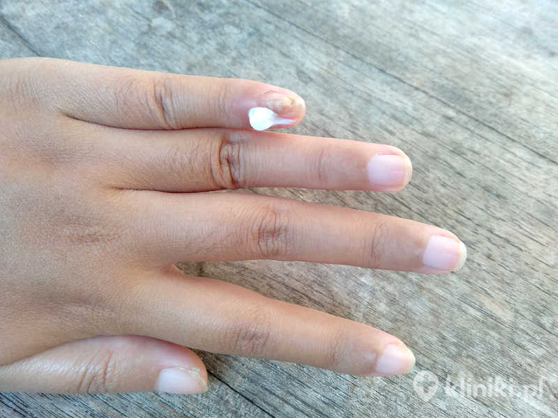 Leczenie grzybicy paznokci może obejmować stosowanie preparatów miejscowych, takich jak lakiery lub kremy przeciwgrzybicze Leczenie grzybicy paznokci może obejmować stosowanie preparatów miejscowych, takich jak lakiery lub kremy przeciwgrzybicze