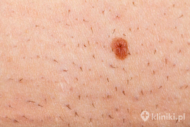 Małe zabiegi chirurgiczne zazwyczaj nie wymagają hospitalizacji ani długiej rekonwalescencji Małe zabiegi chirurgiczne zazwyczaj nie wymagają hospitalizacji ani długiej rekonwalescencji